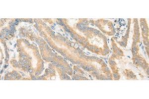 Immunohistochemistry of paraffin-embedded Human thyroid cancer tissue using EPB41L4B Polyclonal Antibody at dilution of 1:35(x200)