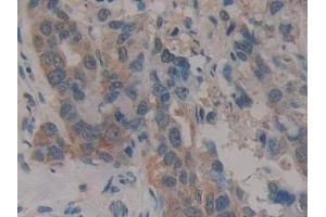 Detection of CARD9 in Human Breast cancer Tissue using Polyclonal Antibody to Caspase Recruitment Domain Family, Member 9 (CARD9)