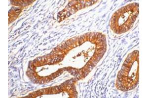 Immunohistochemistry (IHC) image for anti-Carcinoembryonic Antigen Gene Family (CEA) antibody (ABIN3178614) (CEA anticorps)