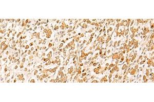 Immunohistochemistry of paraffin-embedded Human gastric cancer tissue using HTT Polyclonal Antibody at dilution of 1:25(x200) (Huntingtin anticorps)