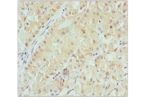 Immunohistochemistry of paraffin-embedded human gastric cancer using ABIN7145471 at dilution of 1:100