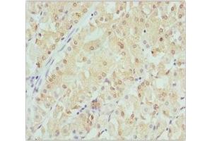 Immunohistochemistry of paraffin-embedded human gastric cancer using ABIN7145471 at dilution of 1:100 (CRYGS anticorps  (AA 1-178))