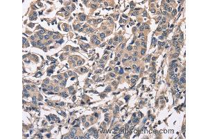 Immunohistochemistry of Human breast cancer using PEBP1 Polyclonal Antibody at dilution of 1:50 (PEBP1 anticorps)