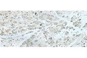 Immunohistochemistry of paraffin-embedded Human lung cancer tissue using THTPA Polyclonal Antibody at dilution of 1:70(x200) (THTPA anticorps)