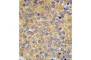 Formalin-fixed and paraffin-embedded human prostata carcinoma tissue reacted with PLAU antibody (N-term), which was peroxidase-conjugated to the secondary antibody, followed by DAB staining. (PLAU anticorps  (N-Term))