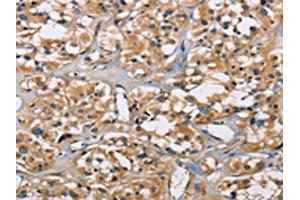 The image on the left is immunohistochemistry of paraffin-embedded Human thyroid cancer tissue using ABIN7130690(PPP3CA Antibody) at dilution 1/30, on the right is treated with fusion protein. (PPP3CA anticorps)