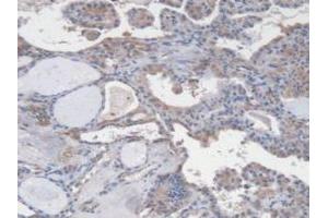 Detection of VEGF121 in Human Thyroid Cancer Tissue using Monoclonal Antibody to Vascular Endothelial Growth Factor 121 (VEGF121)