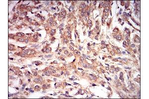 Immunohistochemical analysis of paraffin-embedded prostate cancer tissues using PRKAG1 mouse mAb with DAB staining.