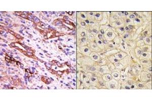 (LEFT)Formalin-fixed and paraffin-embedded human cancer tissue reacted with the primary antibody, which was peroxidase-conjugated to the secondary antibody, followed by DAB staining. (GRK1 anticorps  (C-Term))