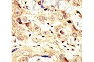 IHC analysis of FFPE human breast carcinoma tissue stained with the HER4 antibody (ERBB4 anticorps  (AA 25-55))