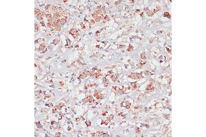 Immunohistochemistry of paraffin-embedded Human breast cancer using Desmoplakin antibody (ABIN6134106, ABIN6139838, ABIN6139840 and ABIN6223548) at dilution of 1:100 (40x lens). (Desmoplakin anticorps  (AA 1-100))