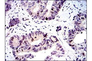 Immunohistochemistry (IHC) image for anti-Baculoviral IAP Repeat-Containing 5 (BIRC5) antibody (ABIN1845166) (Survivin anticorps)