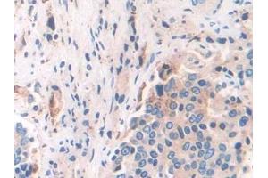 Detection of IFI30 in Human Prostate cancer Tissue using Polyclonal Antibody to Interferon Gamma Inducible Protein 30 (IFI30)