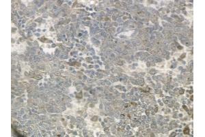 ABIN6259318 and ABIN6274720 at 1/100 staining human melanoma by IHC-P. (MRPS18C anticorps  (Internal Region))