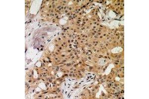 Immunohistochemical analysis of MNK1 (pT250) staining in human breast cancer formalin fixed paraffin embedded tissue section. (MKNK1 anticorps  (pSer250))