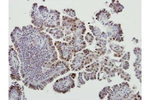 IHC-P Image Immunohistochemical analysis of paraffin-embedded human lung cancer, using MDM2, antibody at 1:500 dilution. (MDM2 anticorps  (Center))