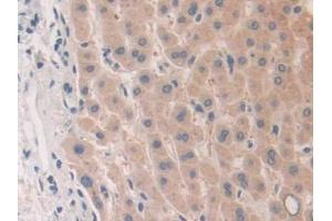 IHC-P analysis of Human Liver cancer Tissue, with DAB staining. (PLA2G10 anticorps  (AA 32-165))