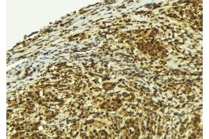 ABIN6279170 at 1/100 staining Human breast cancer tissue by IHC-P.