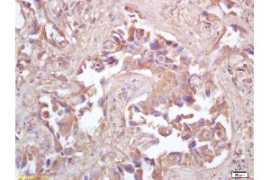 Formalin-fixed and paraffin embedded human lung carcinoma labeled with Rabbit Anti HSP10/CPN10 Polyclonal Antibody, Unconjugated (ABIN721885) at 1:200 followed by conjugation to the secondary antibody and DAB staining (HSPE1 anticorps  (AA 51-102))