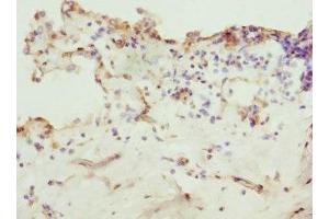 Immunohistochemistry of paraffin-embedded human breast cancer using ABIN7176368 at dilution of 1:100 (ZNF549 anticorps  (AA 1-280))