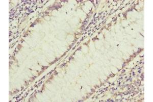 Immunohistochemistry of paraffin-embedded human colon cancer using ABIN7154562 at dilution of 1:100