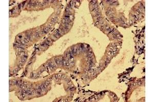 Immunohistochemistry analysis of human endometrial cancer using ABIN7171717 at dilution of 1:100