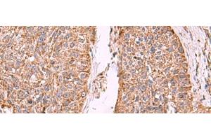 Immunohistochemistry of paraffin-embedded Human esophagus cancer tissue using PER3 Polyclonal Antibody at dilution of 1:55(x200)