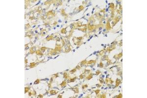 Immunohistochemistry of paraffin-embedded human stomach using Snail antibody (ABIN6132675, ABIN6148177, ABIN6148180 and ABIN6221190) at dilution of 1:100 (40x lens).