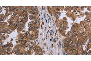 Immunohistochemistry of paraffin-embedded Human ovarian cancer using NDUFAF4 Polyclonal Antibody at dilution of 1:45 (NDUFAF4 anticorps)