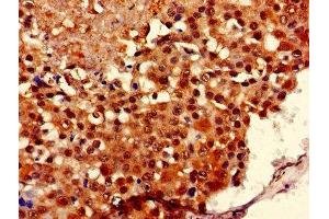 Immunohistochemistry of paraffin-embedded human breast cancer using ABIN7149126 at dilution of 1:100 (UBXN11 anticorps  (AA 38-146))