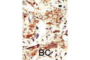 Formalin-fixed and paraffin-embedded human cancer tissue reacted with the primary antibody, which was peroxidase-conjugated to the secondary antibody, followed by AEC staining.