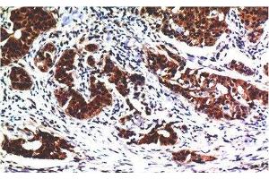 Immunohistochemistry of paraffin-embedded Human breast carcinoma tissue using AKT1 Monoclonal Antibody at dilution of 1:200. (AKT1 anticorps)
