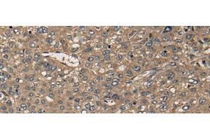 Immunohistochemistry of paraffin-embedded Human liver cancer tissue using CD1B Polyclonal Antibody at dilution of 1:55(x200) (CD1b anticorps)