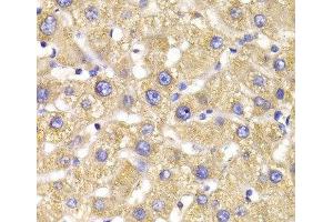 Immunohistochemistry of paraffin-embedded Human liver damage using GPD2 Polyclonal Antibody at dilution of 1:100 (40x lens). (GPD2 anticorps)