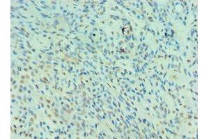 Immunohistochemistry of paraffin-embedded human breast cancer using ABIN7161130 at dilution of 1:100