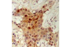 Immunohistochemical analysis of HER2 staining in human breast cancer formalin fixed paraffin embedded tissue section.