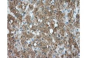 Immunohistochemical staining of paraffin-embedded Carcinoma of liver tissue using anti-SRR mouse monoclonal antibody. (SRR anticorps)
