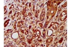 IHC image of ABIN7158186 diluted at 1:400 and staining in paraffin-embedded human pancreatic cancer performed on a Leica BondTM system. (LRRC45 anticorps  (AA 222-357))