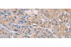 Immunohistochemistry of paraffin-embedded Human liver cancer tissue using ZADH2 Polyclonal Antibody at dilution of 1:100(x200) (ZADH2 anticorps)