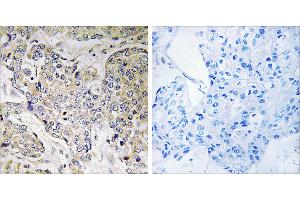Peptide - +Immunohistochemistry analysis of paraffin-embedded human breast carcinoma tissue using CEP41 antibody. (CEP41 anticorps)