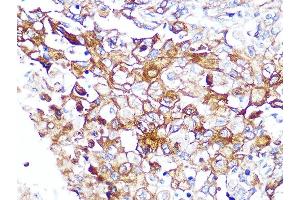 Immunohistochemistry of paraffin-embedded human esophageal cancer using Caveolin-2 Rabbit mAb (ABIN7266155) at dilution of 1:100 (40x lens).