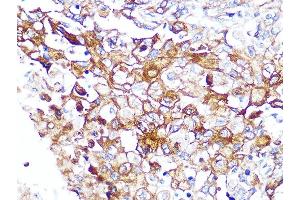 Immunohistochemistry of paraffin-embedded human esophageal cancer using Caveolin-2 Rabbit mAb (ABIN7266155) at dilution of 1:100 (40x lens). (Caveolin 2 anticorps)