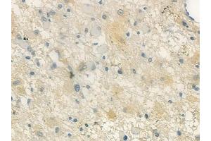 ABIN6258837 and ABIN6273483 at 1/100 staining human astrocytoma by IHC-P.
