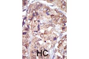 Formalin-fixed and paraffin-embedded human cancer tissue reacted with the primary antibody, which was peroxidase-conjugated to the secondary antibody, followed by AEC staining.