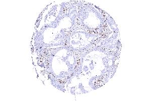 Pulmonary adenocarcinoma with complete loss of SMARCA4 staining of tumor cells