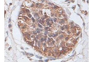 Immunohistochemical staining of formalin-fixed paraffin-embedded human prostate carcinoma tissue showing cytoplasmic and membrane staining with PTP4A2 polyclonal antibody  at 1 : 100 dilution. (PTP4A2 anticorps  (AA 2-167))
