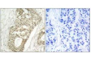 Immunohistochemical analysis of paraffin-embedded human breast carcinoma tissue, using PKC delta (phospho-Ser645) antibody. (PKC delta anticorps  (pSer645))