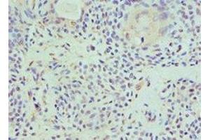 Immunohistochemistry of paraffin-embedded human breast cancer using ABIN7155290 at dilution of 1:100