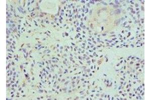 Immunohistochemistry of paraffin-embedded human breast cancer using ABIN7155290 at dilution of 1:100 (HAT1 anticorps  (Catalytic Subunit))