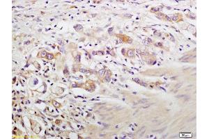 Formalin-fixed and paraffin embedded human gastric carcinoma labeled with Anti-Cytokeratin 19 Polyclonal Antibody, Unconjugated (ABIN678488) at 1:200 followed by conjugation to the secondary antibody and DAB staining